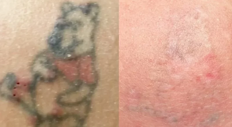 What is laser tattoo removal?