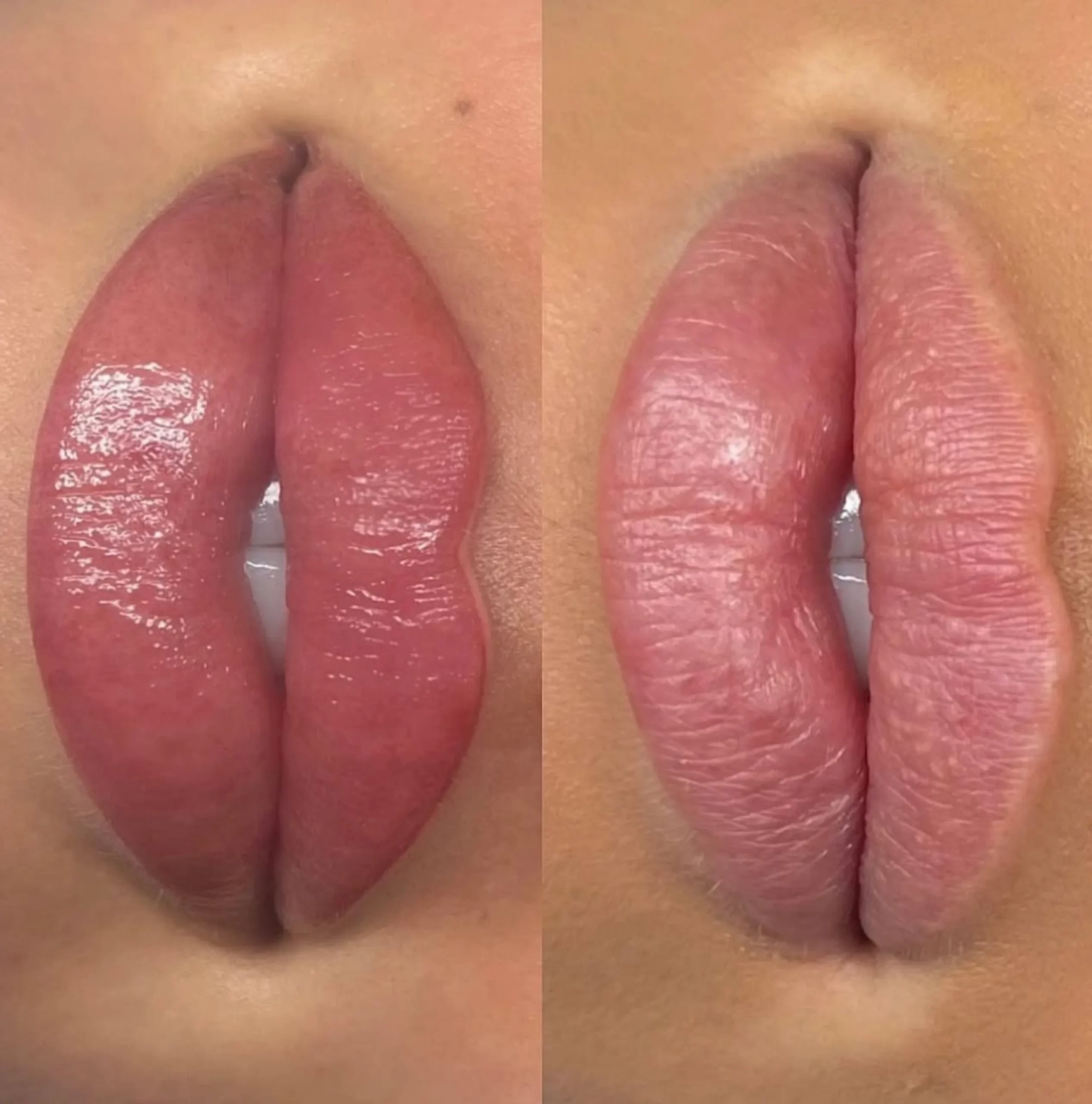 lip fillers, Llip Blush