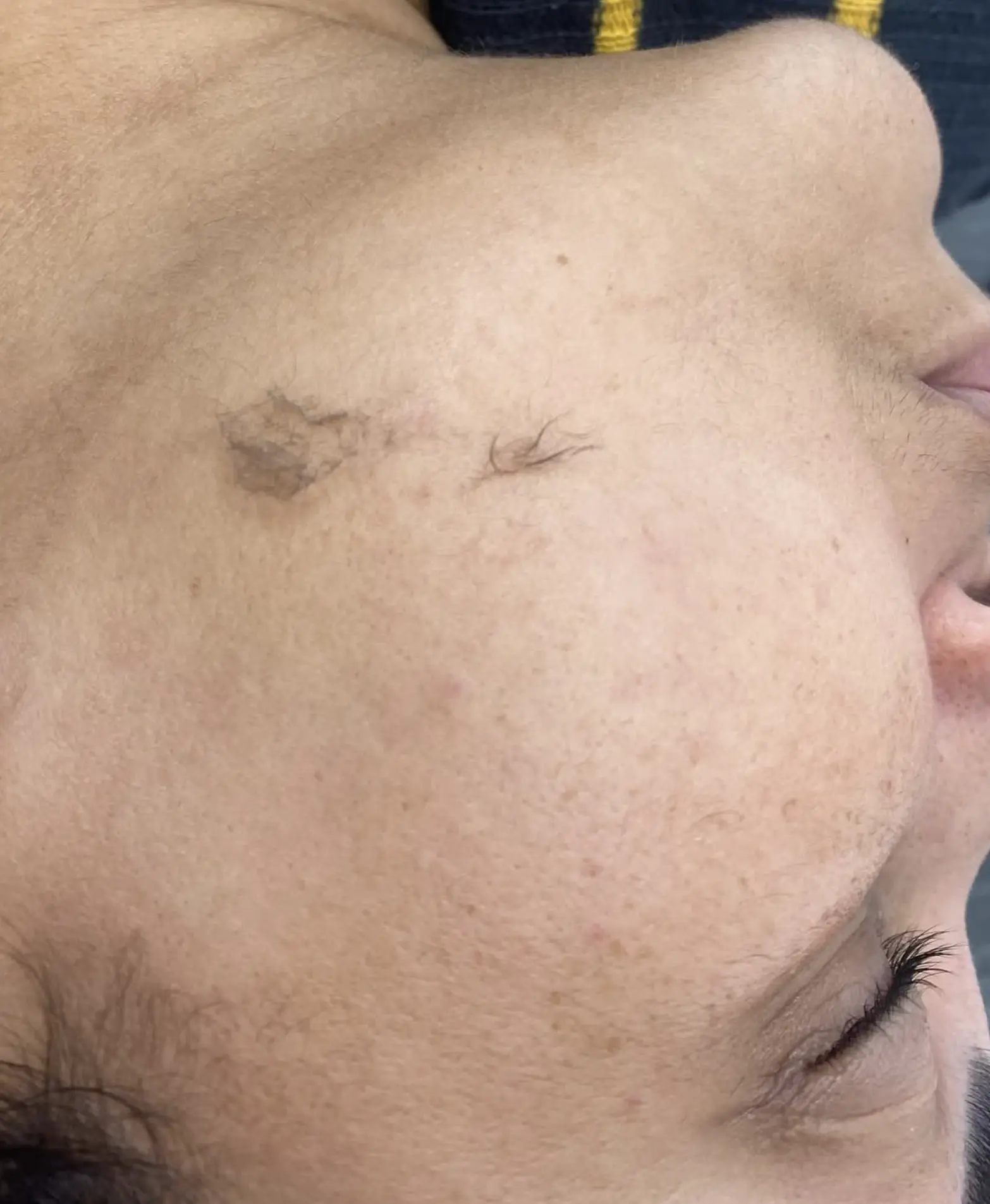 dermaplaning before and aftercare