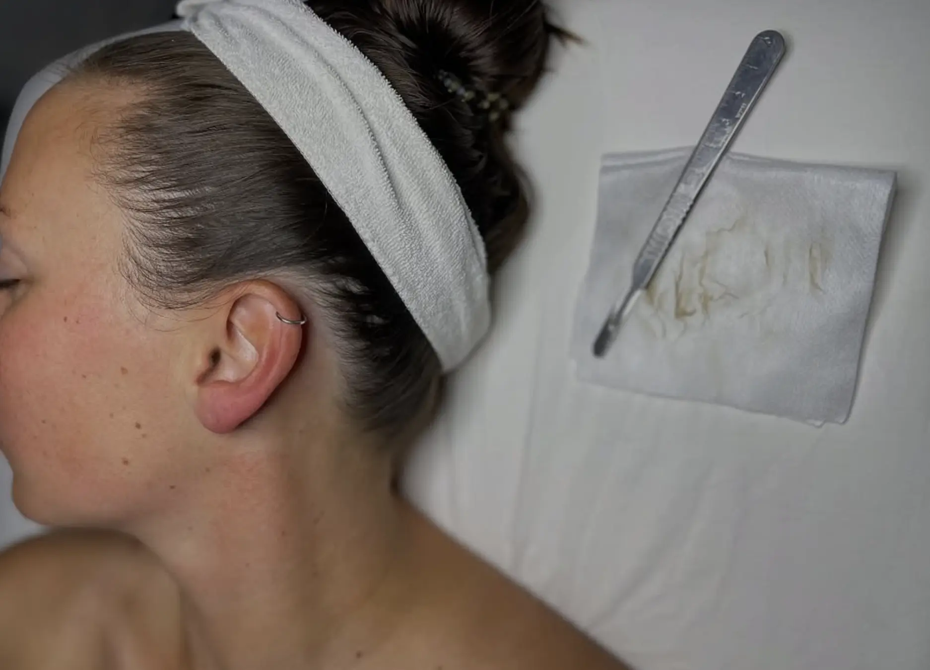 dermaplaning benefits