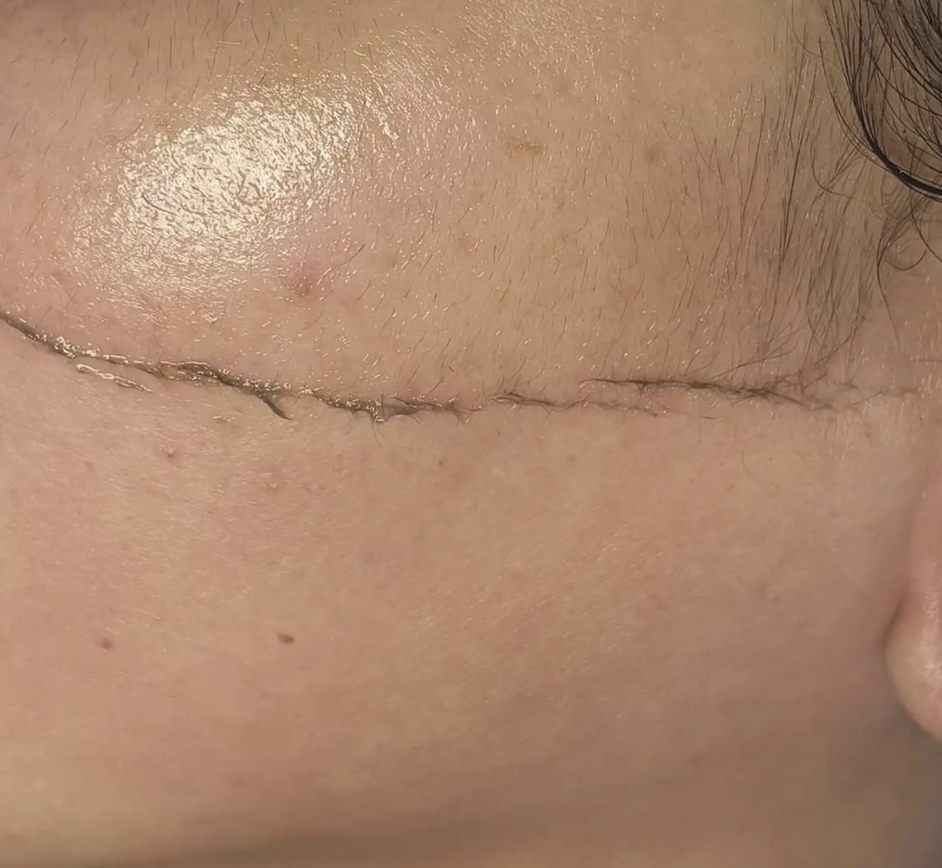 dermaplaning vs chemical peels
