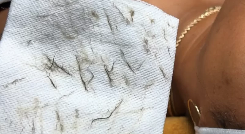 is dermaplaning good for your face