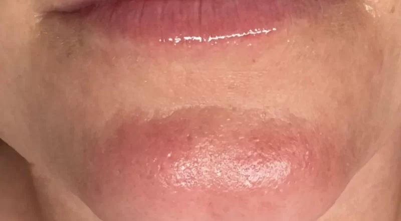 are extractions safe