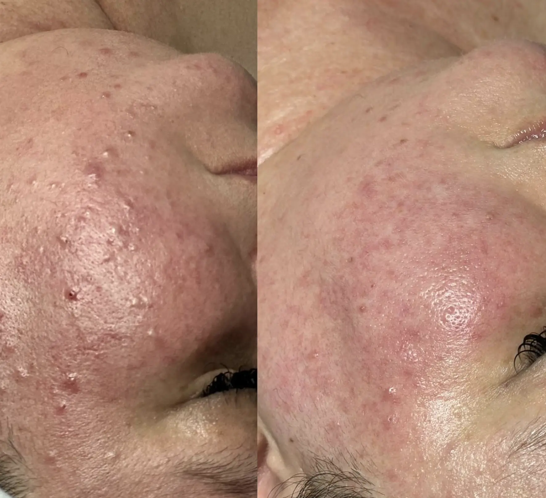 are facial extractions good for your skin