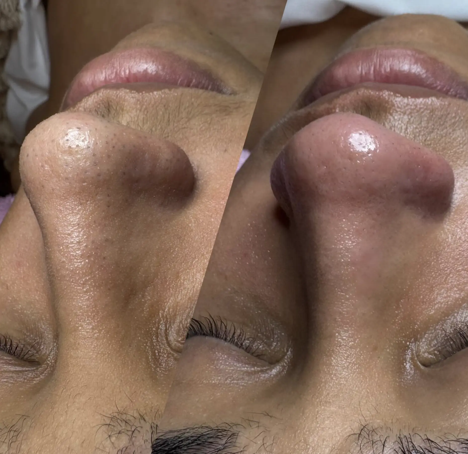 are facial extractions good