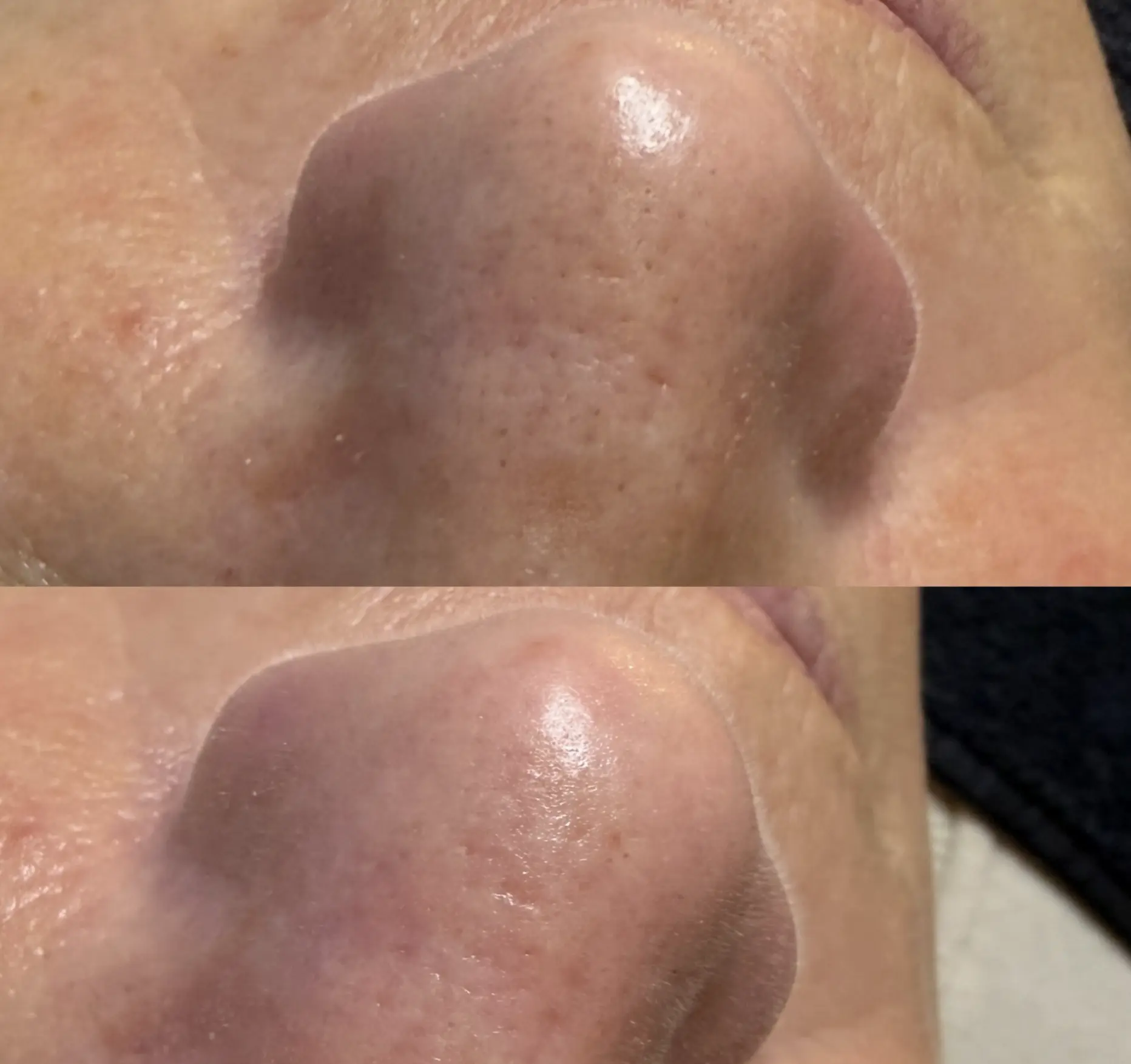 are facial extractions necessary
