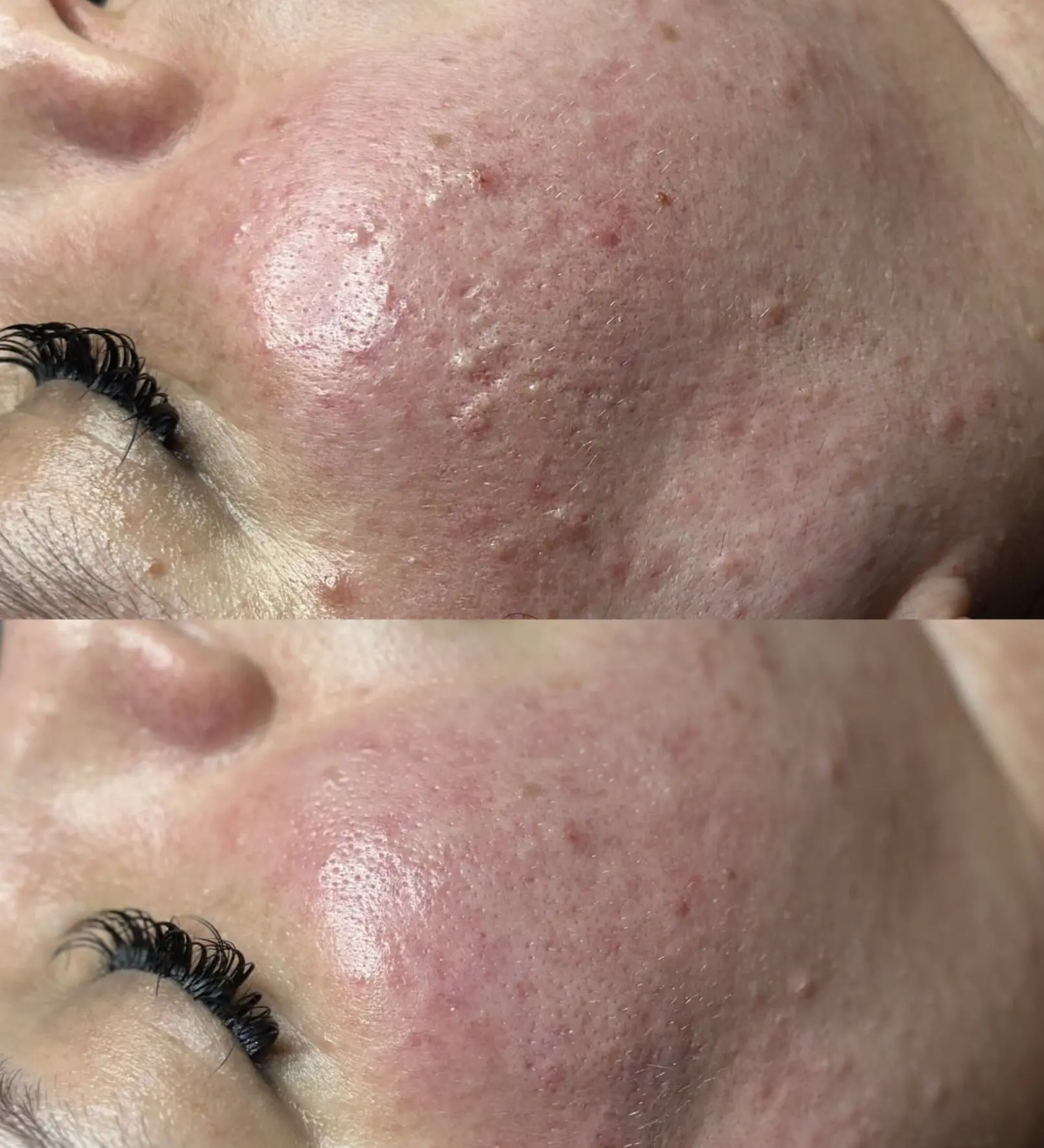 do facial extractions work