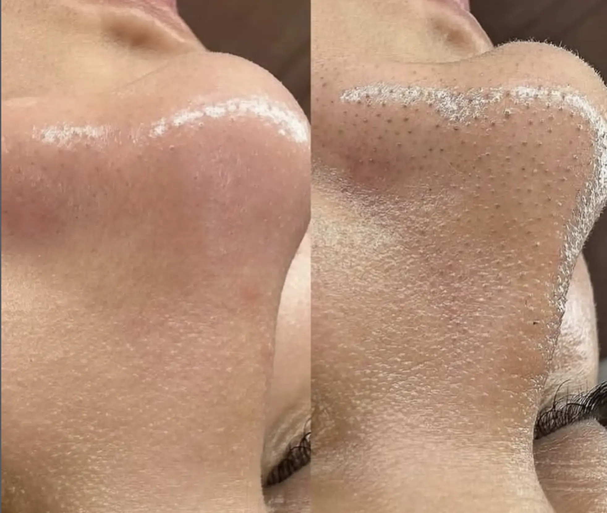 types of facial extractions